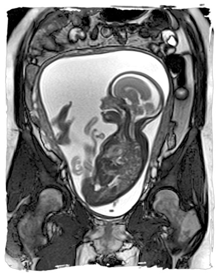 دلایل انجام ام آر آی جنین در بارداری