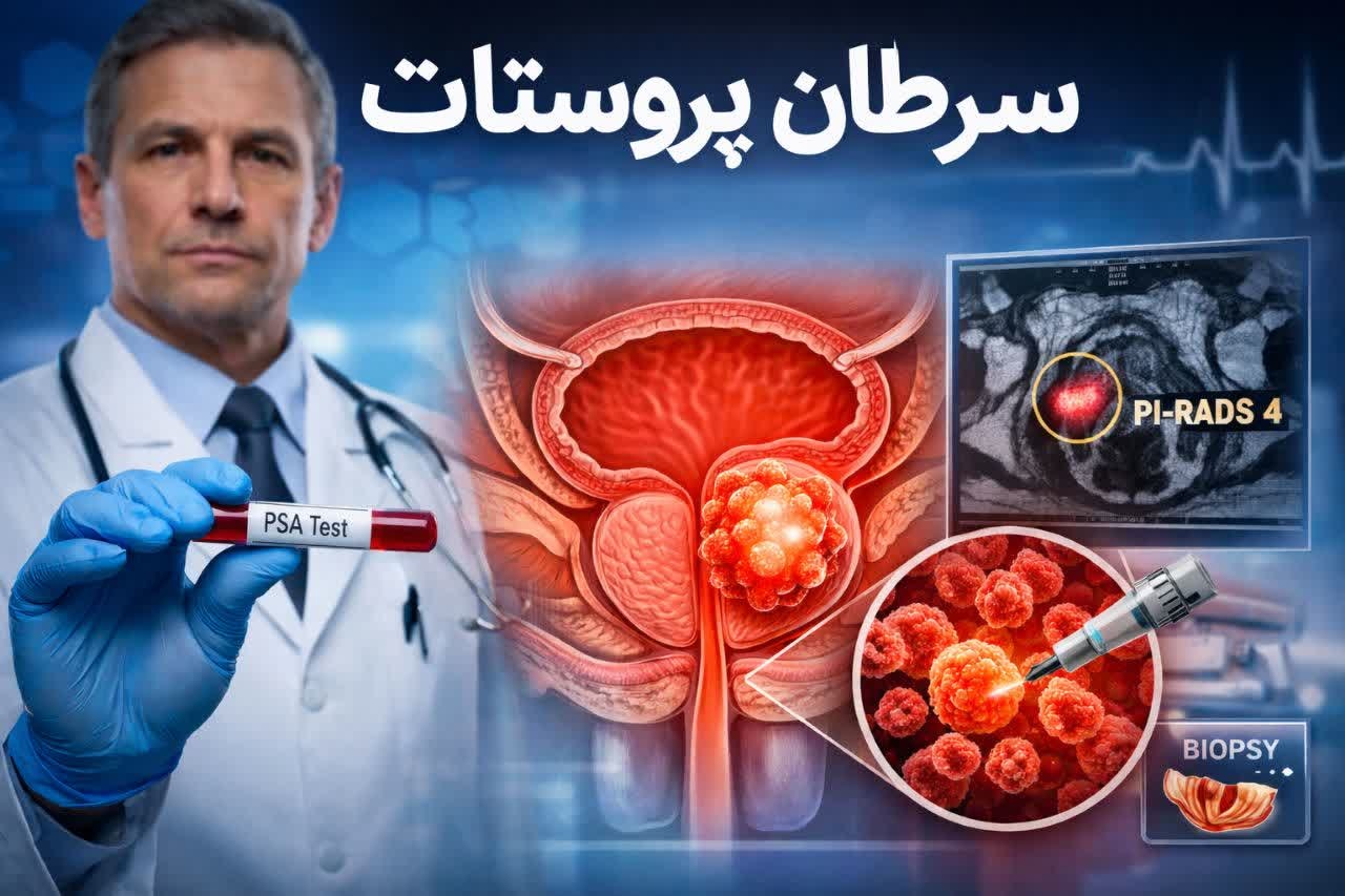 سرطان پروستات: علائم , تشخیص