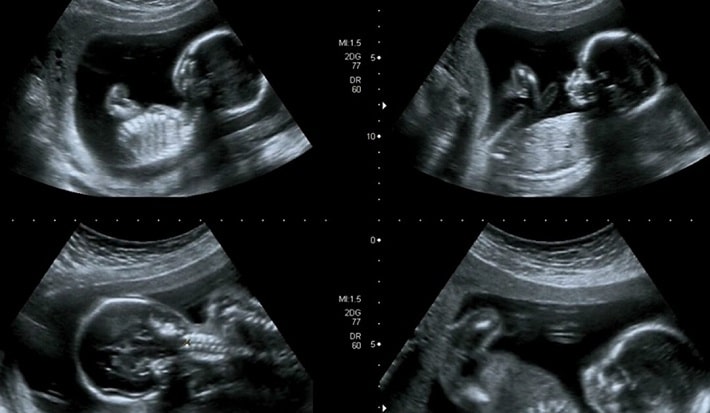 سونوگرافی آنومالی اسکن